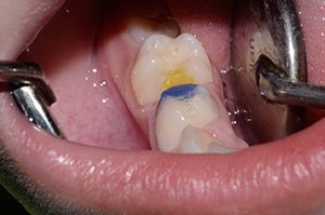 Лечение кариеса зубов у ребенка