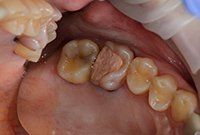 Пломбирование кариозной полости в моляре