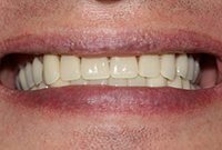 Установка съемного протеза при адентии обеих челюстей