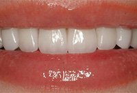 Косметический дефект бокового резца — реставрация