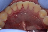 Чистка пигментированного зубного налета