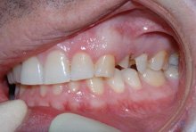 Восстановление премоляров на верхней челюсти