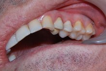 Восстановление премоляров на верхней челюсти