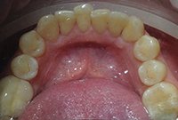 Чистка бактериального налета на зубах