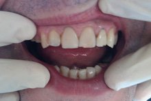 Протезирование передних зубов металлокерамикой