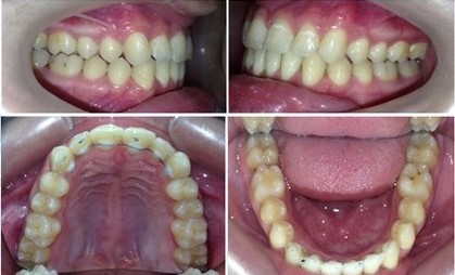 Лечение патологии прикуса элайнерами