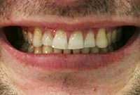 Протезирование верхней челюсти циркониевой коронкой