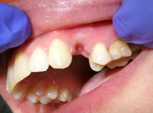 Трансдентальное шинирование при отсутствующем зубе