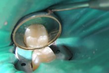 Пломбирование жевательного зуба при лечении кариеса