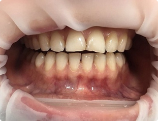 Отбеливание зубов по технологии Zoom 4