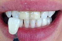 Восстановление центральных резцов циркониевыми коронками