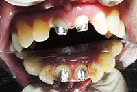 Протезирование верхней и нижней челюстей пластиночными протезами