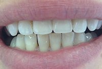 Восстановление центральных резцов циркониевыми коронками