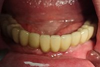 Съемное протезирование балочной конструкцией