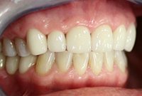 Установка керамических коронок на каркасе из диоксида циркония