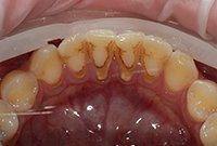 Чистка пигментированного зубного налета