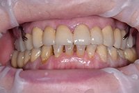 Восстановление зубов металлокерамикой и бюгельным протезом