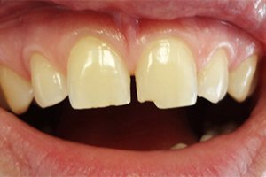 Реставрация сколов передних зубов