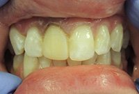 Установка виниров на зубы с флюорозом