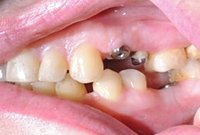 Установка металлокерамических коронок Shofu Halo