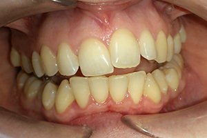 Лечение прикуса комбинированными брекетами Ormco