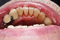 Профилактика заболеваний пародонта — снятие зубных отложений