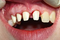 Протезирование резцов верхней челюсти коронками