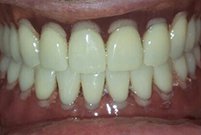 Съемное протезирование при полной адентии