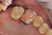 Пломбирование кариозной полости в моляре