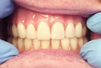 Протезирование полным покрывным протезом на балке