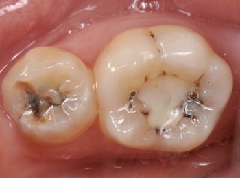 Цветная пломба Твинки Стар при лечении кариеса у ребенка