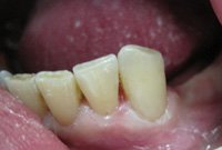 Лечение рецидивного кариеса под пломбой