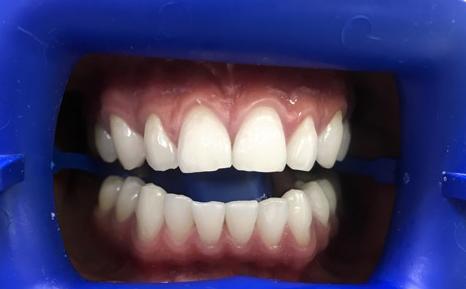 Отбеливание зубов по технологии Zoom White Speed