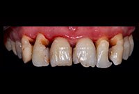 Протезирование полным покрывным протезом на балке