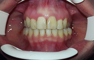 Исправление прикуса при скученности зубов