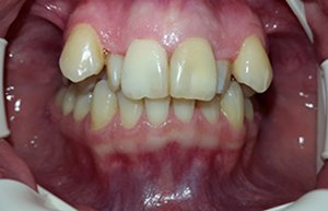 Исправление прикуса при скученности зубов