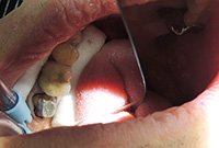 Установка вкладки при реставрации разрушенного зуба