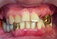 Протезирование металлокерамикой и установка бюгельного протеза