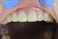 Протезирование верхнего зубного ряда телескопическими коронками