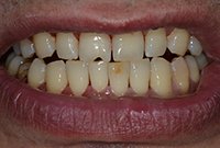 Лечение дисколорита зубов — профессиональная чистка