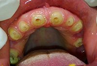 Полное протезирование при адентии верхней челюсти