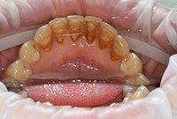 Профессиональная чистка зубного камня