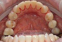 Профессиональная гигиена зубов и десен