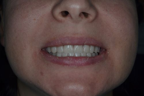 Комплексная реконструкция улыбки