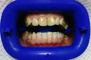 Осветление зубной эмали профессиональной системой ZOOM