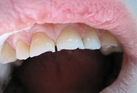 Реставрация режущего края передних зубов