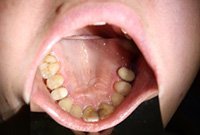 Восстановление премоляров керамическими коронками на золоте