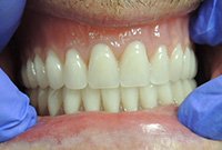 Протезирование верхней и нижней челюстей пластиночными протезами