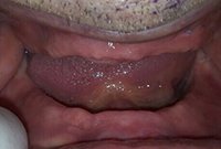 Съемное протезирование при полной адентии