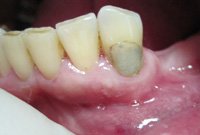 Лечение рецидивного кариеса под пломбой